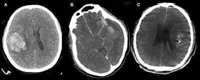 Delayed Progressive Mass Effect After Secured Ruptured Middle Cerebral Artery Aneurysm: Risk Factors and Outcomes